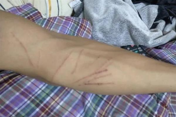 被兔子抓伤后的处理方式，尽快清洗伤口